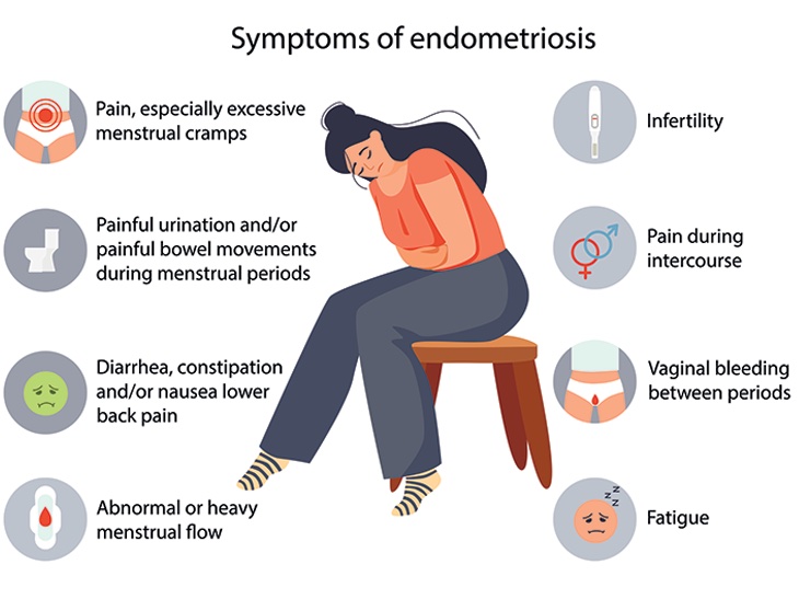 Symptoms of endometriosis